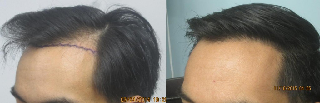 The Benefits of Hair Transplant Surgery for Filipino Males