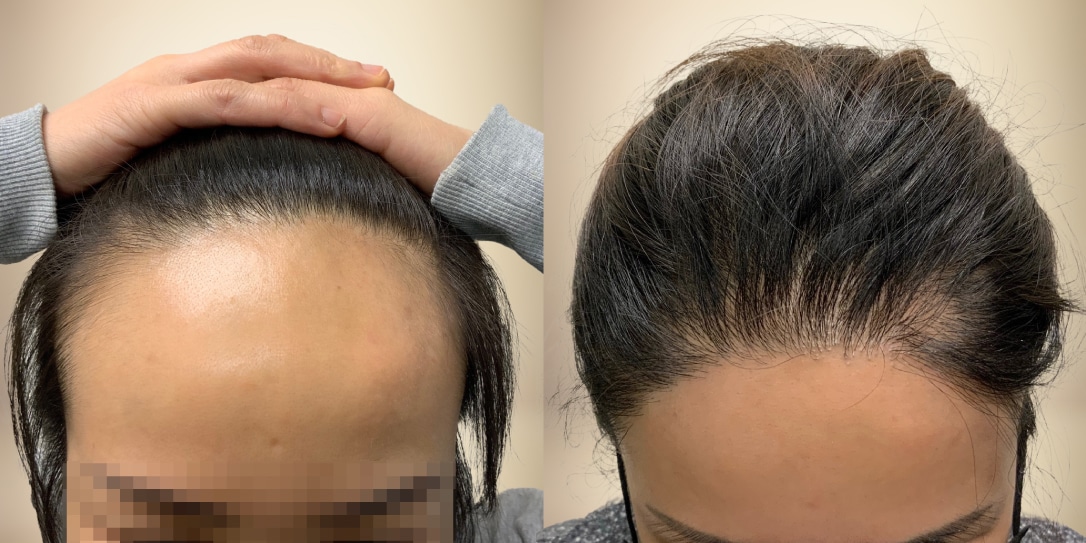 The Pros of Hair Transplant Surgery for Filipino Females